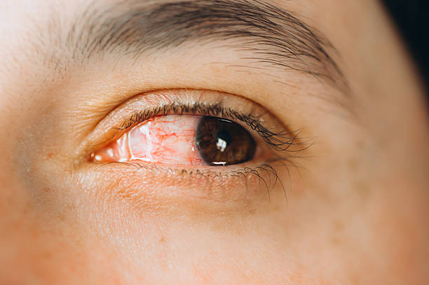 Eye Infection Treatment Aizawl