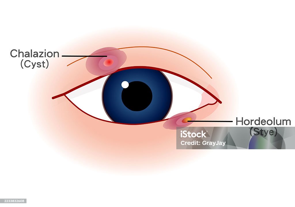Eye Infection Treatment Aizawl